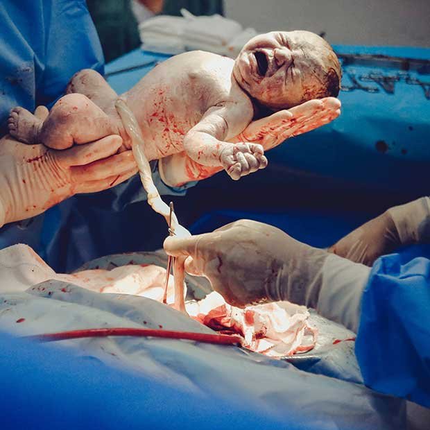 Caesarean Operation